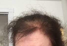 can minoxidil change hair texture if