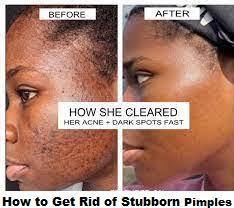 stubborn pimples with remes