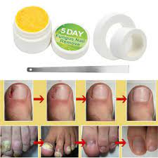 20g toe nail fungus cream treatment