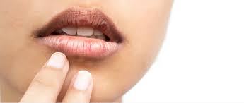 how to treat sunburned lips causes