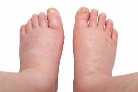 swollen feet treatments singapore