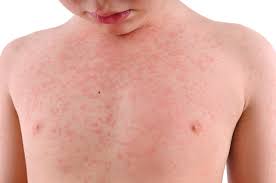 an allergic reaction rash