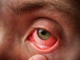 pictures of pink eye conjunctivitis