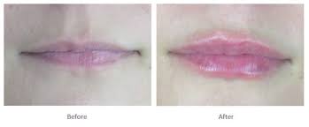 lip filler before and after photos and