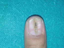 nail dystrophy in a ager springerlink