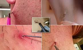 Causes can include a clogged hair follicle or a very close shave. Ingrown Hair Extraction Is Eclipsing Pimple Popping Porn Daily Mail Online