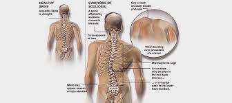 scoliosis exercise learn which ones