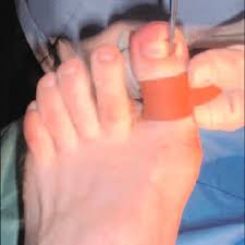 carrying out a partial nail avulsion