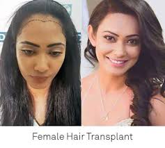 best hair transplant in kolkata hair