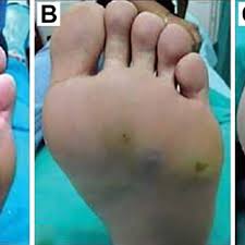 pdf plantar warts epidemiology