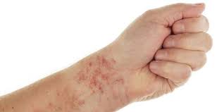 hiv rash is my rash a symptom of hiv
