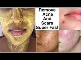 how to remove acne and acne scars super
