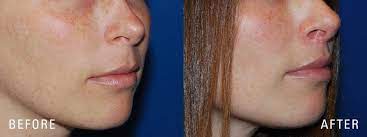 lip lift illume cosmetic surgery