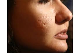 how to get rid of acne scars be