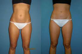 liposuction inner and or outer thighs