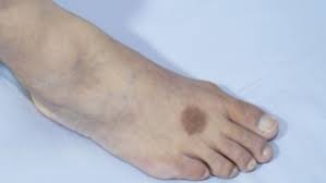 brown spots on feet causes