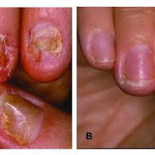 pdf treatment of nail disorders