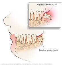 People may require tooth extraction for many reasons, ranging from tooth decay to change the gauze as necessary: Wisdom Tooth Extraction Mayo Clinic