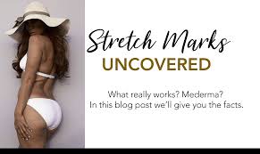 mederma stretch mark cream