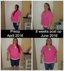 2 Month Post Op Gastric Sleeve Update Including What Im