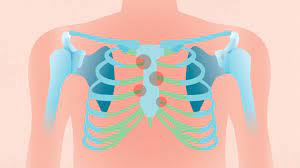 rheumatoid arthritis chest and rib
