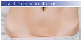 Hysteroscopic correction of cesarean section. The Best Way To Treat A C Section Scar Biodermis Com