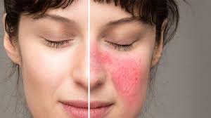 aromatherapy essential oils for rosacea