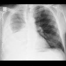 This tumor, previously uncommon, is now observed with increasing frequency in developed countries (pathogenetic relationship with asbestos fibers inhalation is proved). Mesothelioma Radiology Reference Article Radiopaedia Org