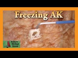 freezing hand actinic keratosis with