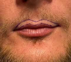 plastic surgery case study lip