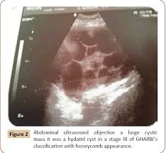 Ultrasonography may sometimes be insufficient for the differential diagnosis of the lesion seen in the images. A Huge Primary Hydatid Cyst Of Uterus A Case Report And Review Of Literature Insight Medical Publishing