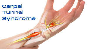 carpal tunnel syndrome london elbow