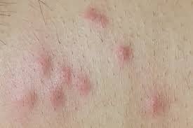 Bed bug bites on humans can do great damage to the skin and healing takes time , so it's important that you begin bed bug bite treatment as soon have a look at these bed bug bite pictures and see if they match your bites. What Do Bed Bug Bites Look Like Bed Bug Identification Prevention