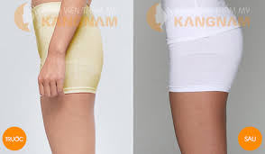 Trước và sau khi phẫu thuật nâng mông nội soi tại thẩm mỹ viện KANGNAM