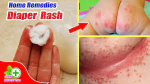 home remes for diaper rash in es