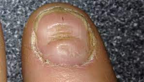derm dx severe ridging along the nails