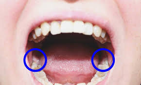 impacted wisdom teeth their causes