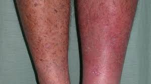 Skin Lesions Pictures Causes Types Risks Diagnosis And