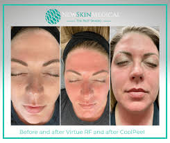 virtue rf and cooll laser treatment