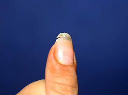 split nail causes treatment and