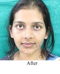 before and after lip reduction surgery