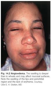 urticaria and angioedema chapter 14
