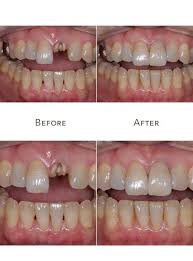 replace a single tooth what to expect