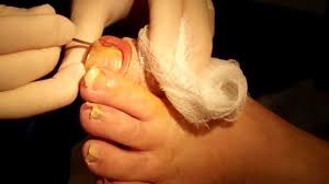 ingrown toenail surgery dr leo