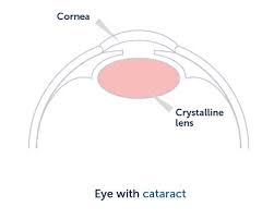 cataract surgery intraocular lenses