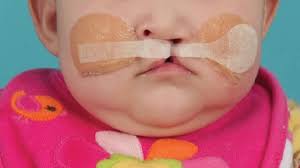 treating cleft lip and palate