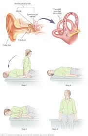 Turn head to the left and lie back quickly. Canalith Repositioning Procedure Mayo Clinic