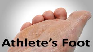 athlete s foot fungus cure in 3 minutes