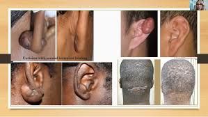 keloid treatment in skin of color new