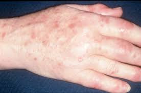 Scalp, vulgaris, guttate, inverse, and pustular. Psoriatic Arthritis Is An Inflammatory Joint Condition Associated With Psoriasis